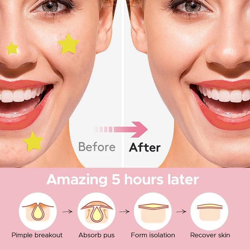 18-600pcs Star Pimple Patch Acne Colorful Invisible Acne Removal Skin Care Stickers Concealer Face Spot Beauty Makeup Tools